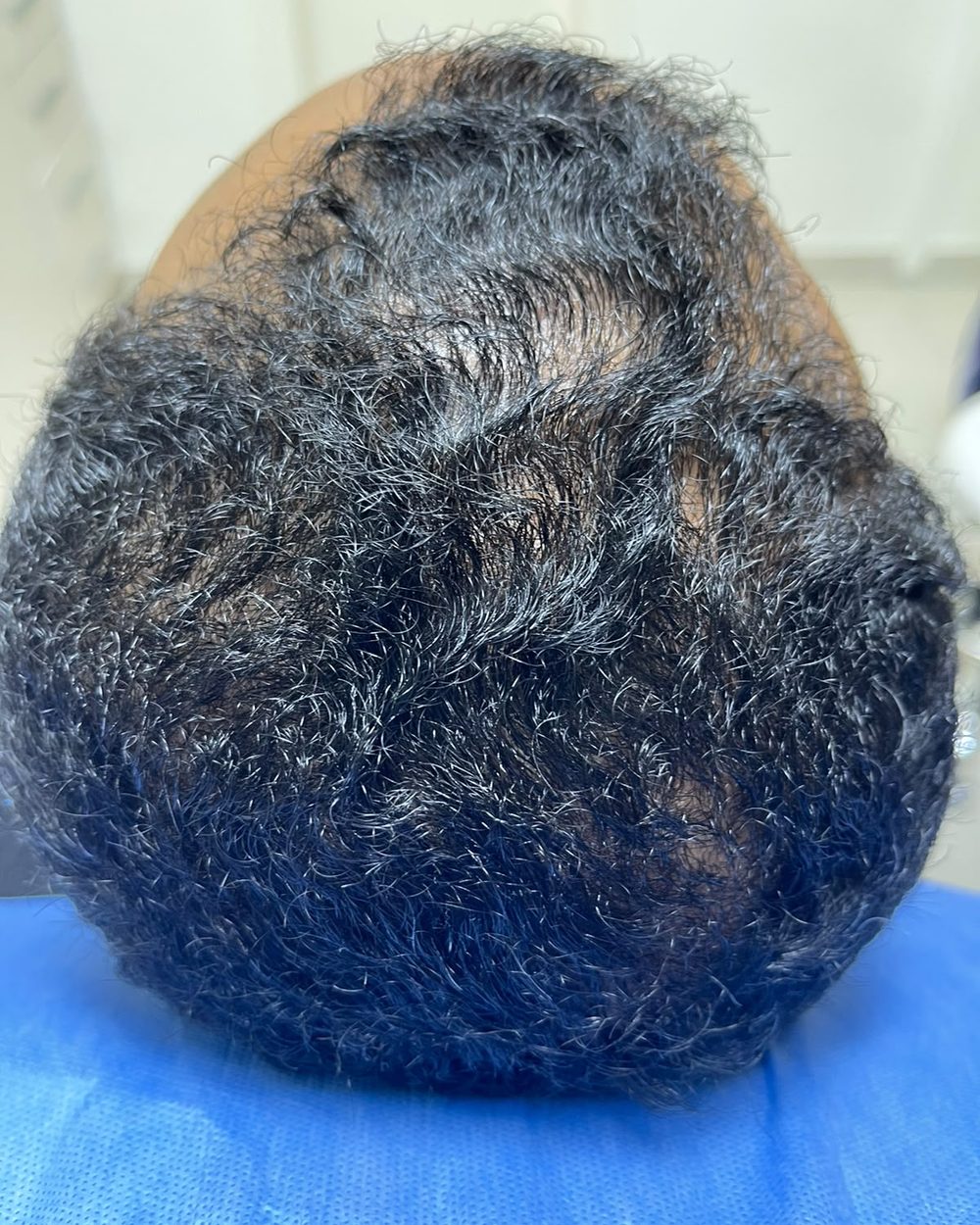 لقطة قريبة لمنطقة التاج قبل العلاج: خفّة واضحة في الشعر وظهور فروة الرأس